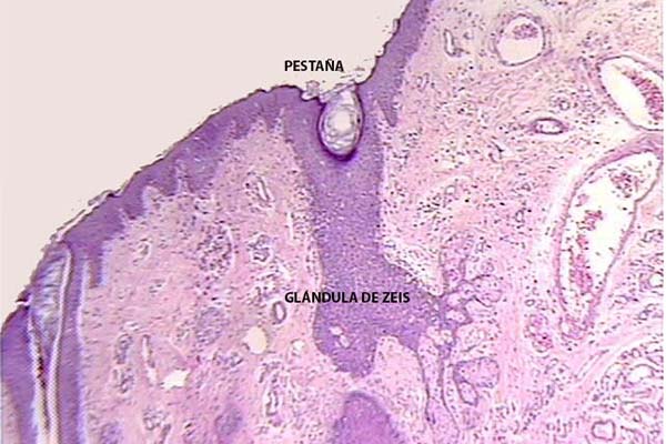 En este momento estás viendo Pestaña y glándula de Zeis respectiva