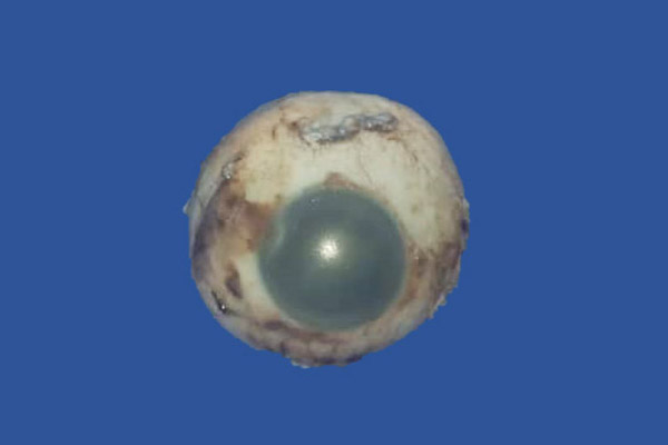 En este momento estás viendo Vista frontal de un globo ocular enucleado