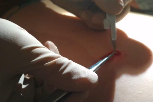 Las biopsias y su fijación
