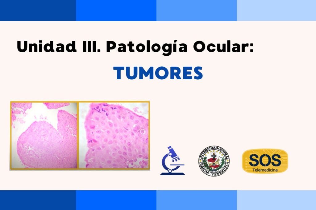 Unidad III. Patología Ocular: Tumores