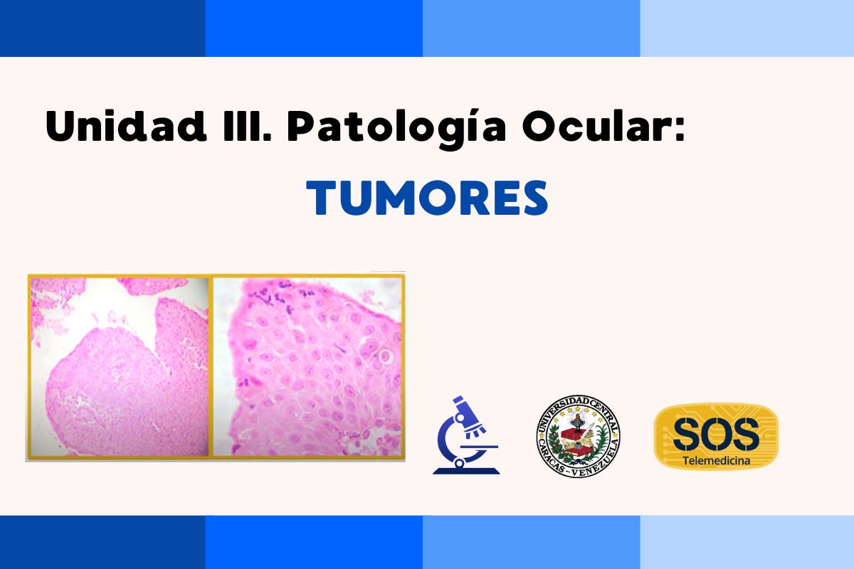 En este momento estás viendo Unidad III. Patología Ocular: Tumores