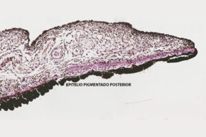 Lee más sobre el artículo Epitelio pigmentado posterior