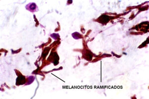 Lee más sobre el artículo Melanocitos ramificados