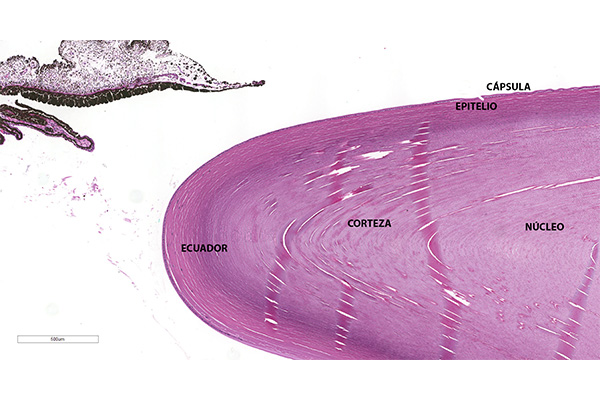 En este momento estás viendo Corteza y núcleo del cristalino