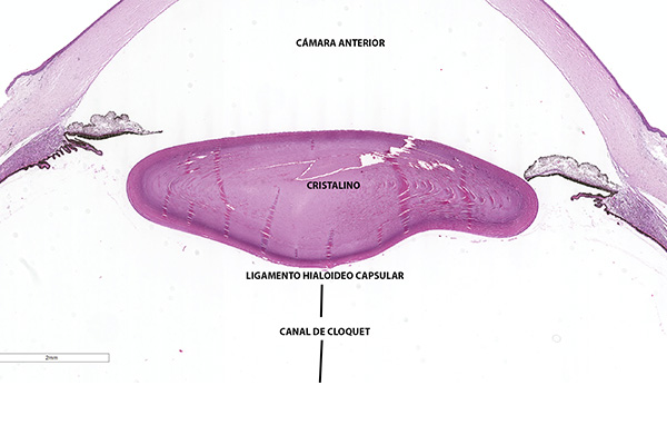 En este momento estás viendo Ligamento hialoideo capsular