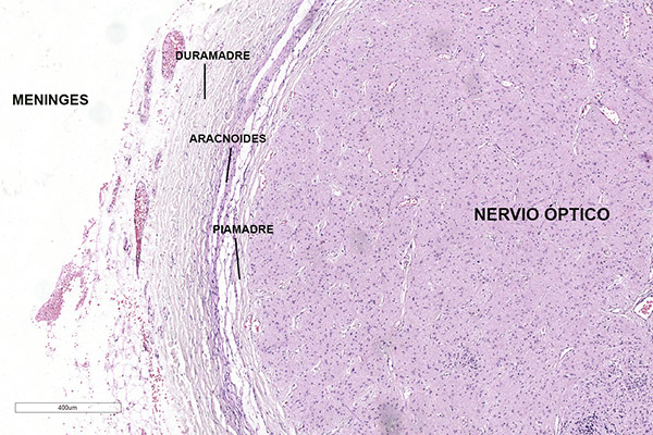 En este momento estás viendo Meninges del nervio óptico