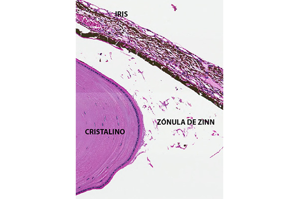 En este momento estás viendo Zónula de Zinn