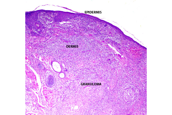 En este momento estás viendo Chalazion