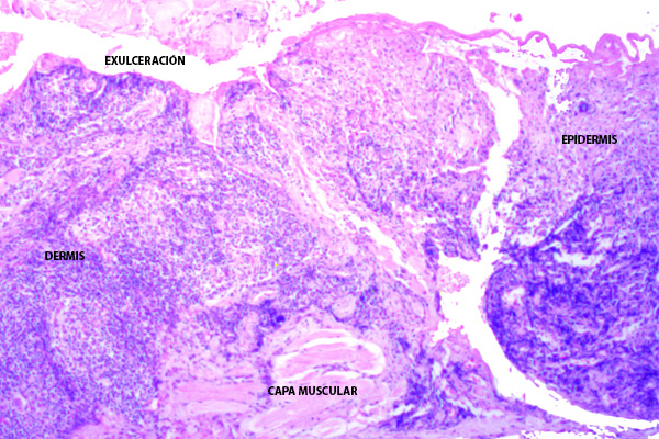 En este momento estás viendo Leishmaniasis