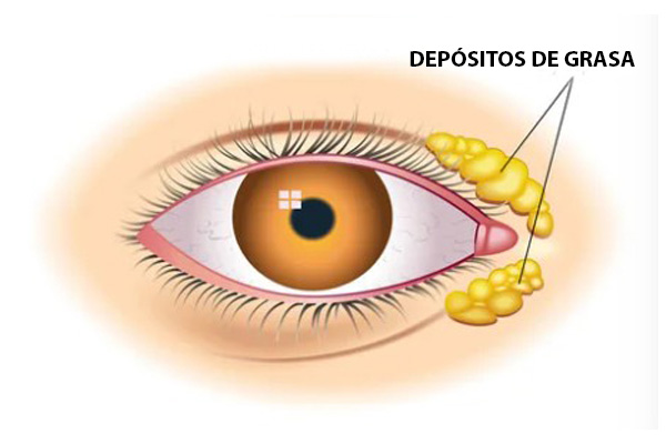 En este momento estás viendo Xantelasma